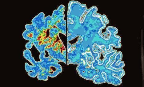 تأثير مرض الزهايمر علي خلايا المخ