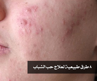 8 طرق طبيعية لعلاج حب الشباب 70