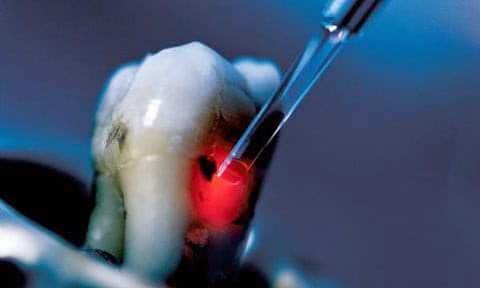 علاج جديد للأسنان بالليزر يساعد علي استعادة نموها بعد تسوسها