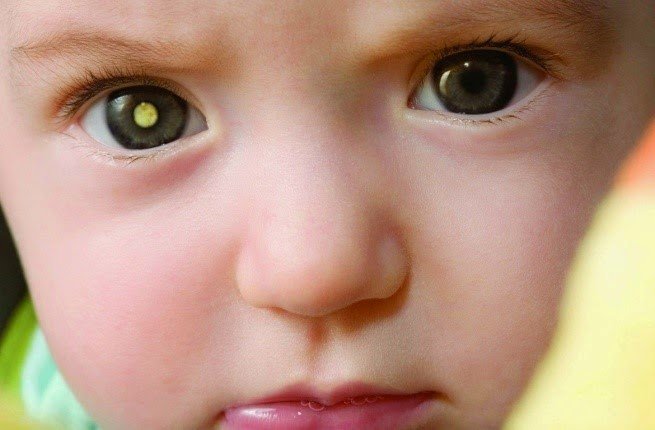 صور الهاتف الجوال تنقذ الأطفال من سرطان شبكية العين !