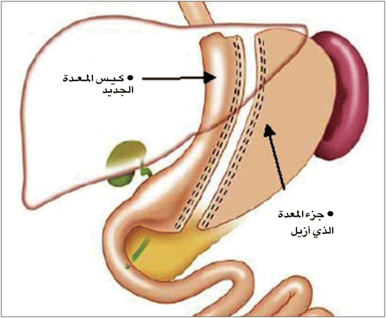 تكميم المعدة بالانجليزي