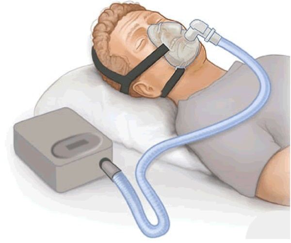 إنقطاع التنفس أثناء النوم و جهاز micro CPAP بدون خراطيم و أسلاك لعلاج المشكلة 2