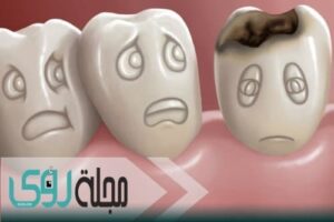 teeth-cavities-natural-remedies