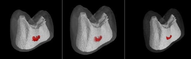 A simulated image of a cavity (in red) shrinking during the new remineralization process. | King’s College London