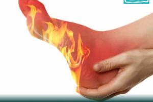 burning-hot-feet