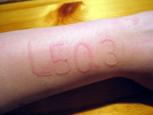 ديرما توغرافيا : مرض الكتابة على الجلد أو كتوبية الجلد – أسبابه وعلاجه