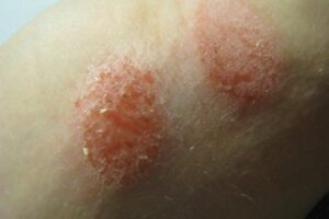 eczema-natural-remedies
