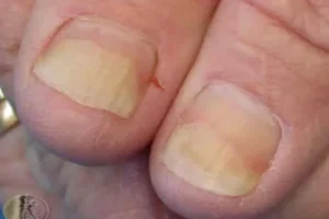 falling-nails-toenails