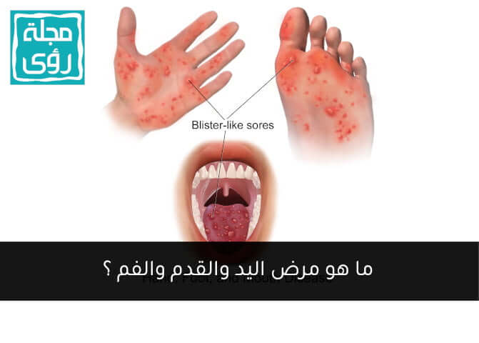 مرض اليد والقدم والفم